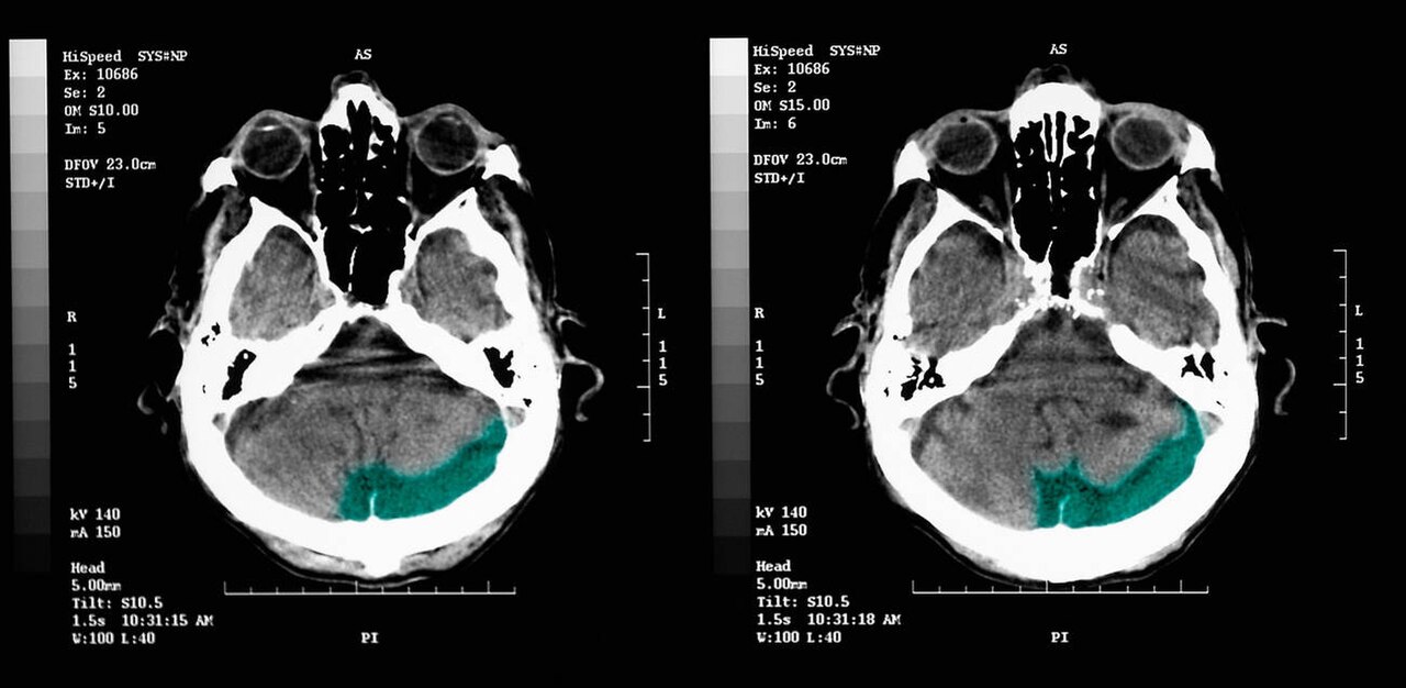 Jepang Uji Coba Teknologi Diagnosis Dini Demensia Berbasis AI